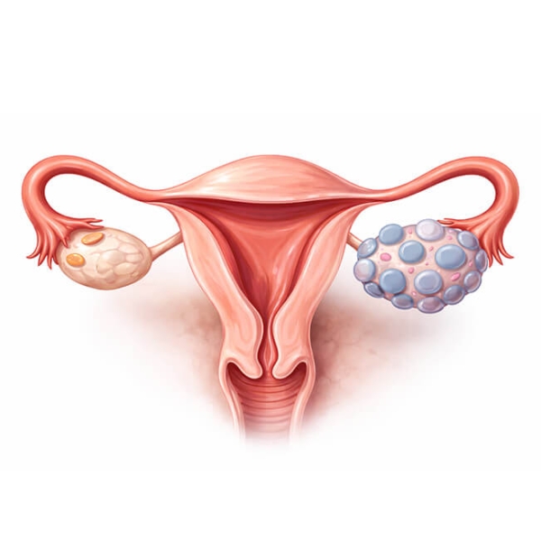 pcos belirtileri nelerdir? erken belirtiler nasıl anlaşılır?