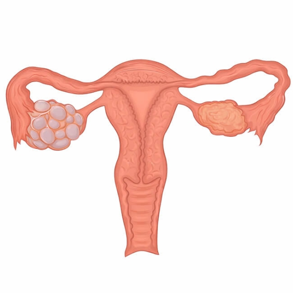 pcos tanısı nasıl konur? hangi testler yapılır?