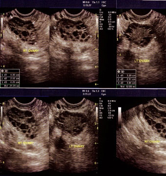 POLİKİSTİK OVER SENDROMU (PCOS)